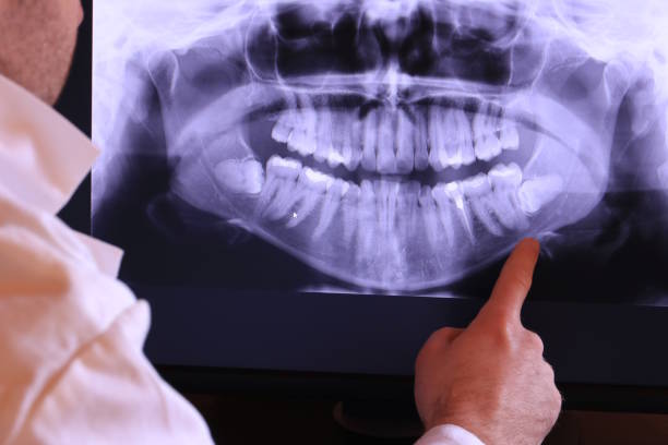Best Emergency Wisdom Teeth Removal in Grayson, GA