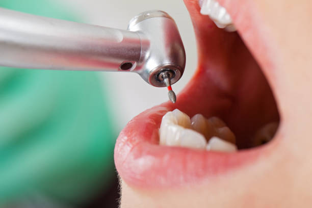Best Emergency Dental Care for Broken or Chipped Teeth in Grayson, GA